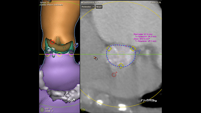 Imagen cl&iacute;nica Philips HeartNavigator
