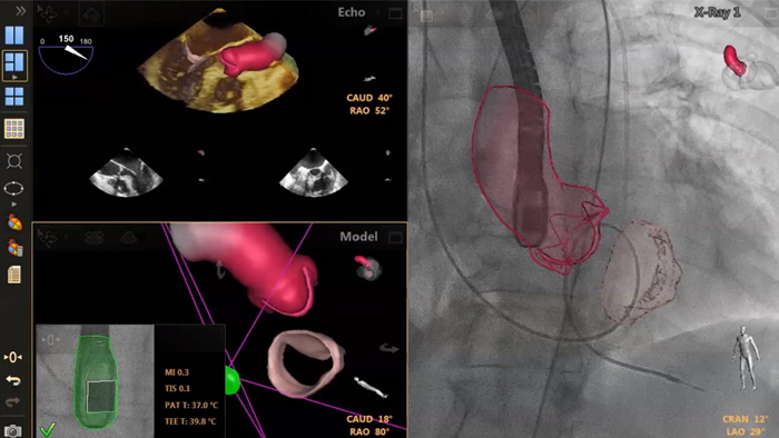 Gu&iacute;a de punci&oacute;n transeptal