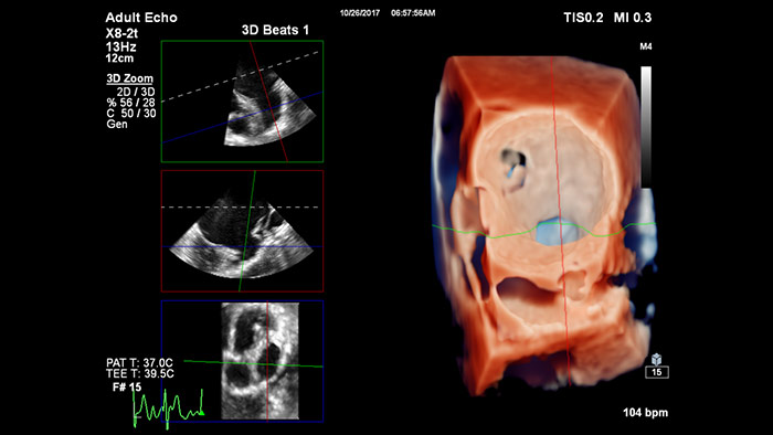 Reproducci&oacute;n con TrueVue con zoom 3D para LAA con visualizaci&oacute;n MultiVue
